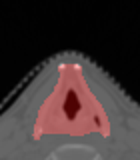 Zoomed CT crop showing larynx glottis